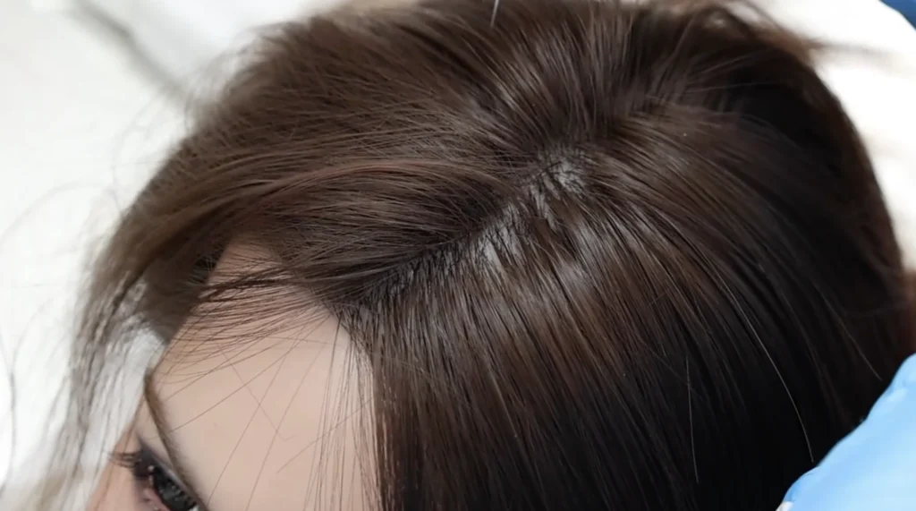 Implanted hair craftsmanship with realistic scalp and natural hairline